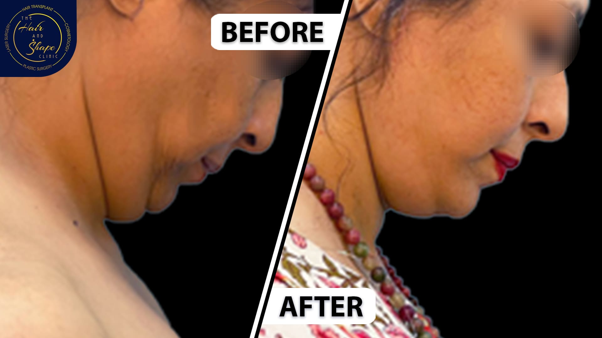 Face & Neck Lift result3
